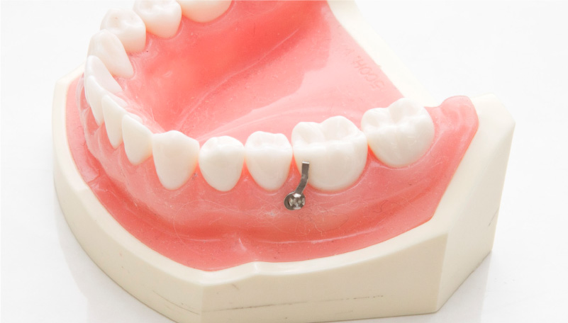 歯科矯正用アンカースクリューを使用した効果的な矯正